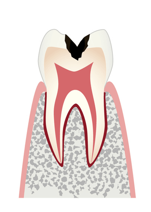 歯の内部まで進行したむし歯