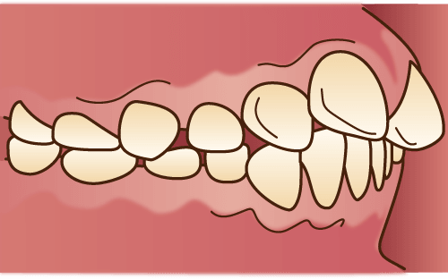 上顎前突（じょうがくぜんとつ）