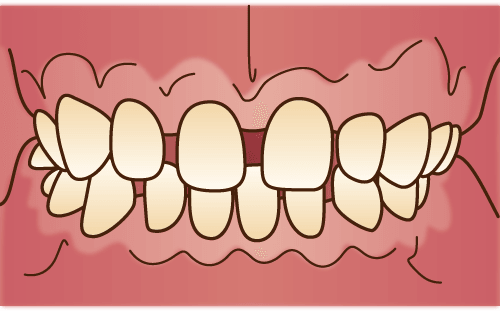 空隙歯列（くうげきしれつ）
